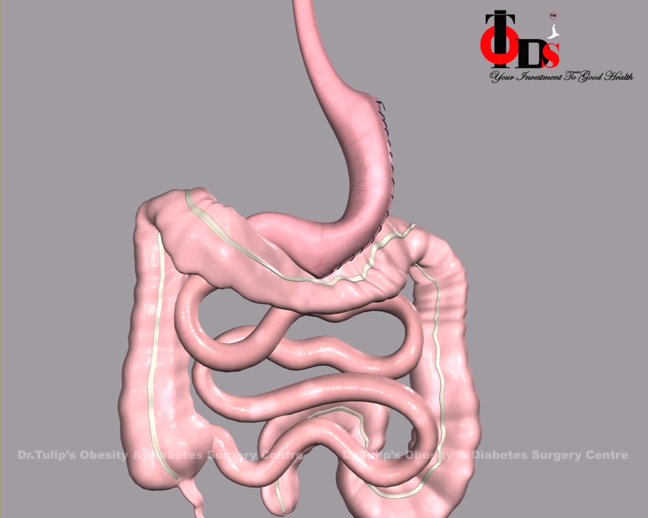  Sleeve Gastrectomy im3